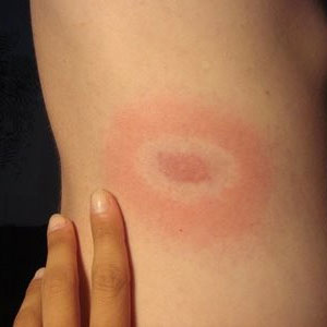 Lyme disease rise in victims