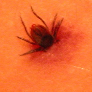 Tick Bites